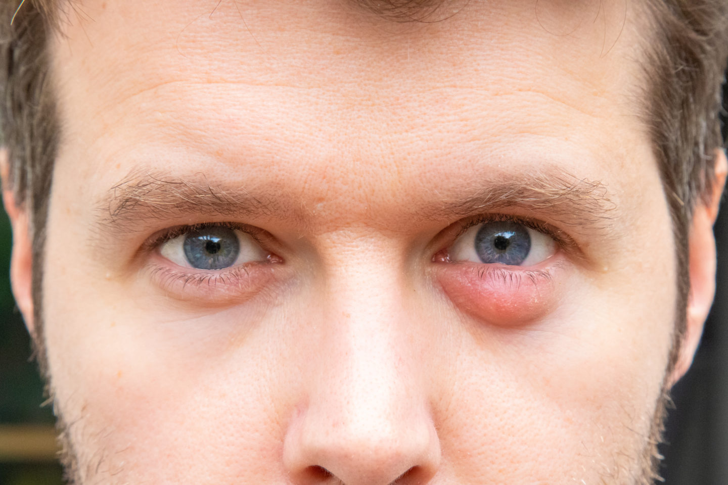 Stye Vs Chalazion First Eye Care DFW North Texas Optometrist